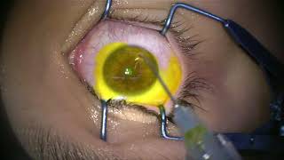 Corneal Collagen Cross Linking for Keratoconus [upl. by Ayo]