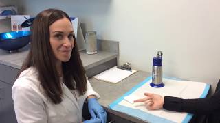 Wart Removal Using Liquid Nitrogen [upl. by Lairbag]