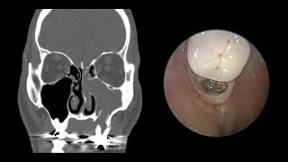 Study Sinus infection Skip antibiotics [upl. by Lleynod]