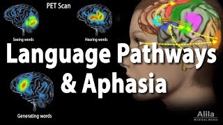 Language Pathways and Aphasia Animation [upl. by Bauer]