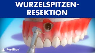 Wurzelspitzenresektion © [upl. by Alyekahs750]