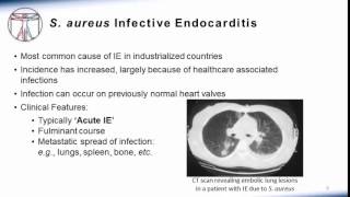 Endocarditis Microbiology and Treatment [upl. by Nilyam]