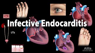 Infective Endocarditis Animation [upl. by Dur849]