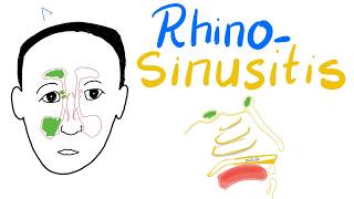 Sinus Infection Causes Signs Symptoms Diagnosis  Dr Harihara Murthy [upl. by Aicinad]