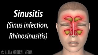 Fungal Sinusitis [upl. by Siuqramed708]