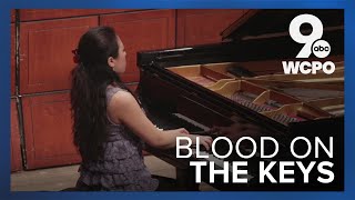 Bloody piano keys Pianist says it doesnt hurt actually [upl. by Brace]